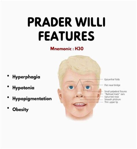 prader willi facial features.